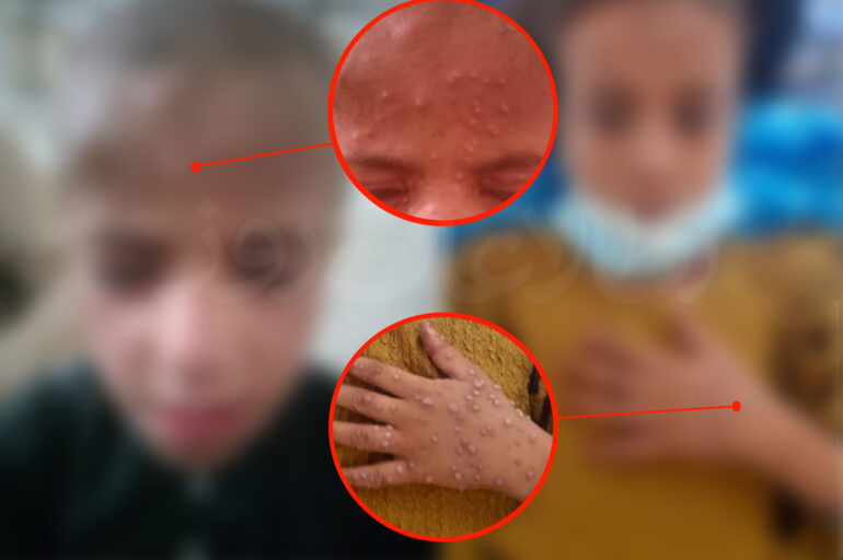 سازمان جهانی بهداشت: آبله میمونی در افغانستان به ثبت نرسیده است