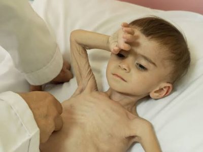 سوءتغذیه شدید؛ نگرانی تازه در جنوب افغانستان